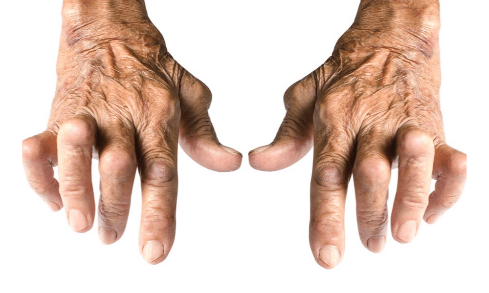 natural treatment for arthritis