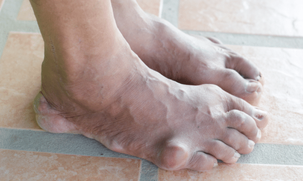 picture of a person's feet showing gout in foot