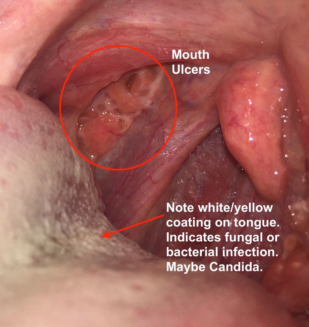throat ulcers symptoms