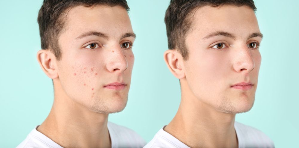 what causes acne